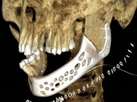 Chirurgia, protesi al titanio nella mandibola mangiata dal tumore